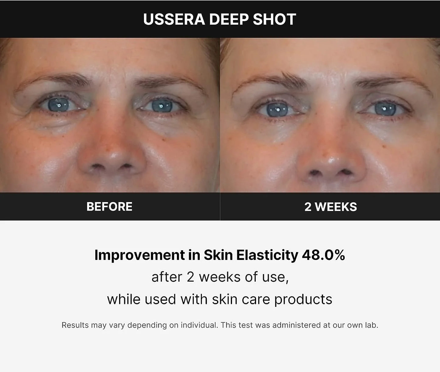 Age-R USSERA Facial Treatment Device - At-Home Skin Care Device for Collagen Stimulation Wrinkle Reduction, and Youthful Complexion - Korean Skin Care